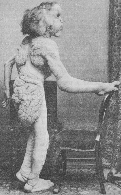Fotografía de Joseph Merrick tomada para el estudio de la enfermedad en 1888.