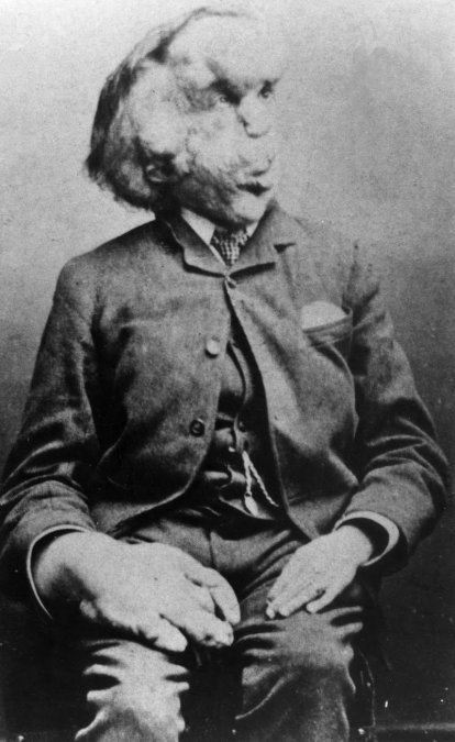 Joseph Merrick fotografiado en 1889.
