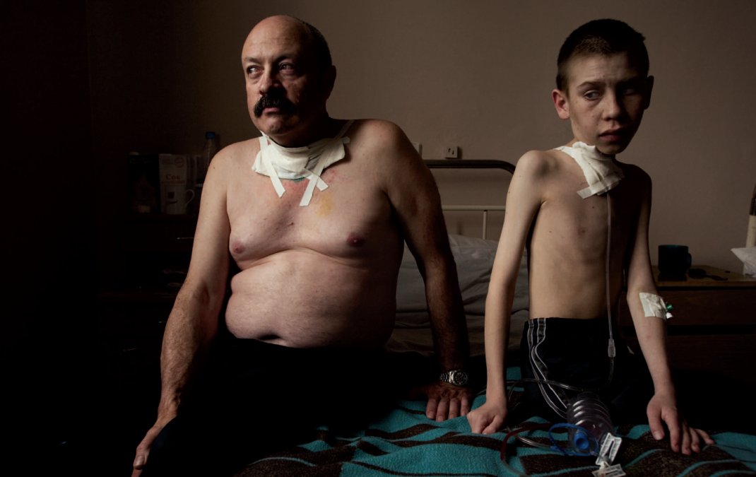 Aquejados de cáncer de tiroides, Oleg Shapiro, de 54 años, y Dima Bogdanóvich, de 13, son atendidos en un centro especializado de Bielorrusia. Shapiro arriesgó su salud demoliendo casas contaminadas cerca del reactor destruido. Dima nació mucho después de la explosión.