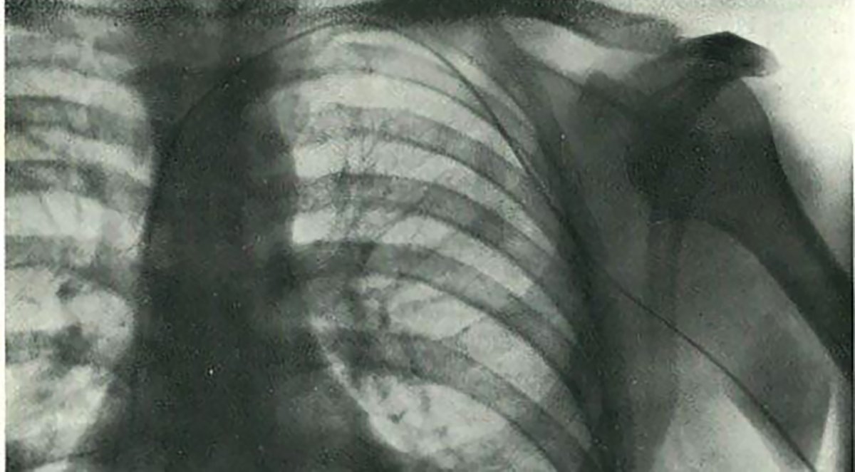  Radiografía mostrando el catéter en el corazón de Werner Forssmann